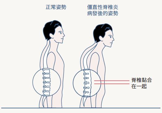 飛克FAAC和僵直性脊椎炎