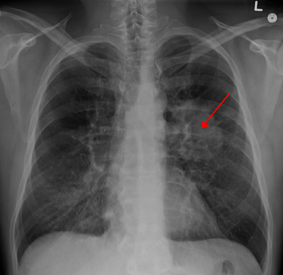 FAAC 肺癌Lung cancer