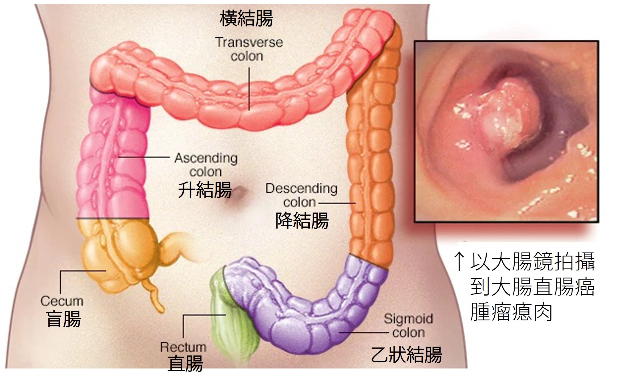 大腸直腸癌 Colorectal cancer