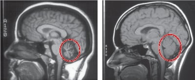 小腦萎縮症 Spinocerebellar Atrophy