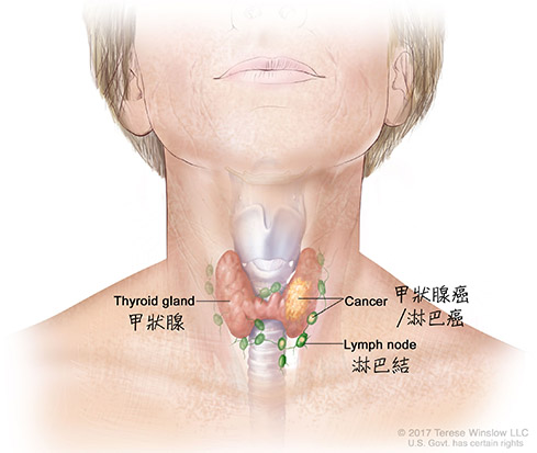 甲狀腺癌/淋巴癌 Thyroid Cancer／Lymphoma