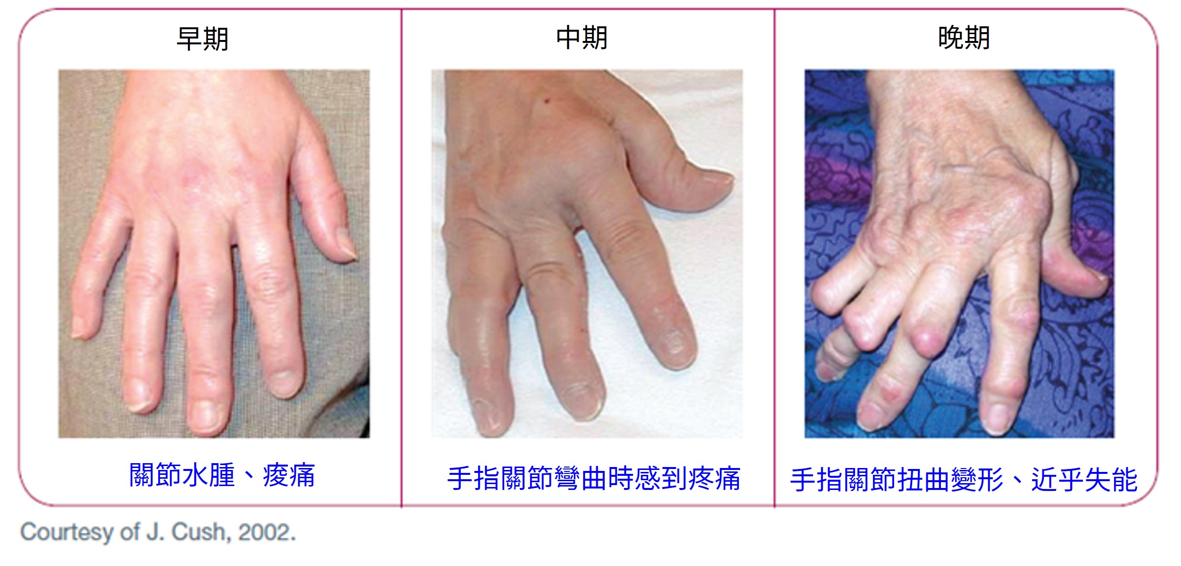 類風濕性關節炎（rheumatoid arthritis, RA）