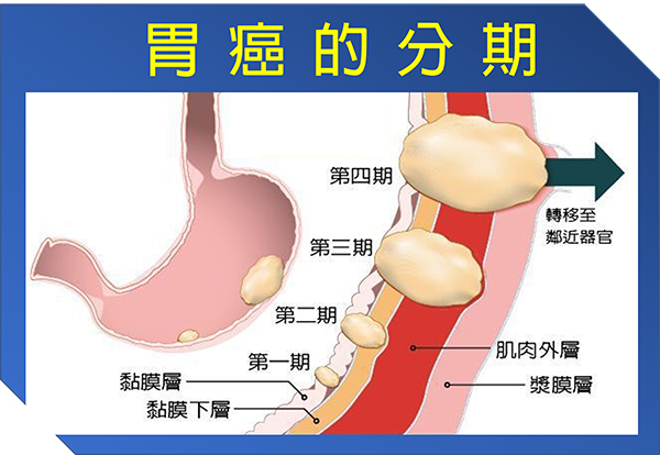 胃癌的分期