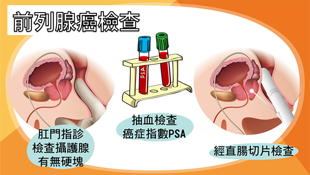 前列腺癌檢查