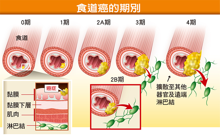 食道癌的分期