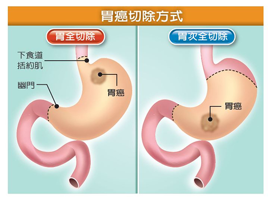 胃癌手術切除方式