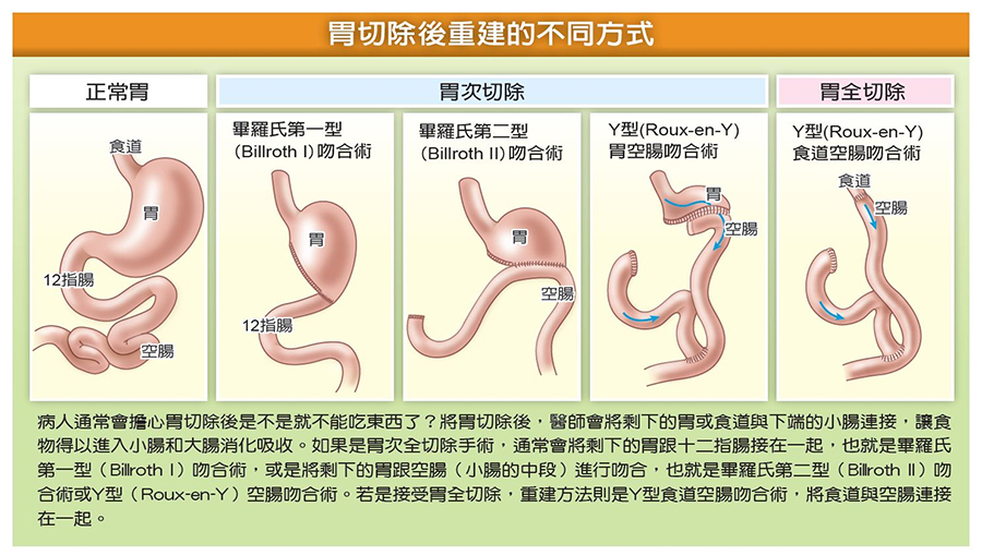 胃切除後重建手術